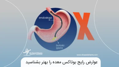 عوارض بوتاکس معده شاخص