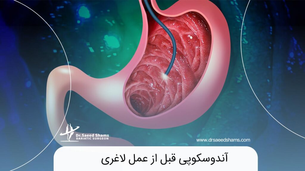 آندوسکوپی قبل از عمل لاغری