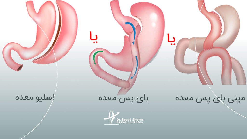 بهترین عمل لاغری