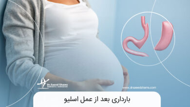بارداری بعد از عمل اسلیو