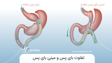 تفاوت بای پس و مینی بای پس