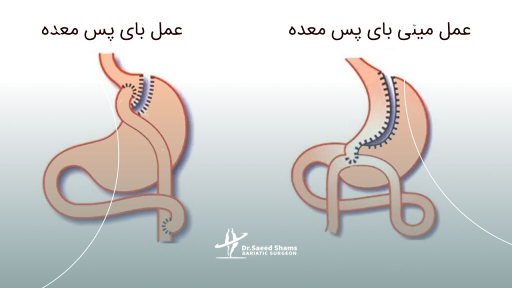 فرق عمل بای پس و مینی بای پس