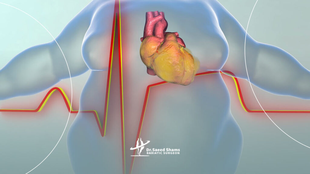 چاقی و بیماری قلبی