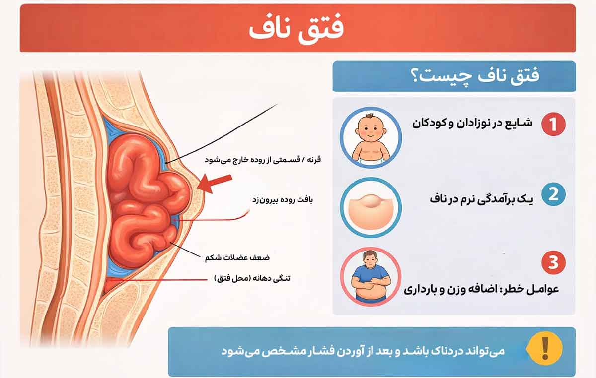 فتق ناف بصورت اینفوگرافیک کامل